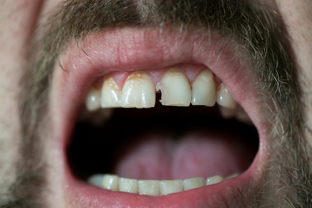 Chipped Tooth Pain: When to Seek Dental Treatment