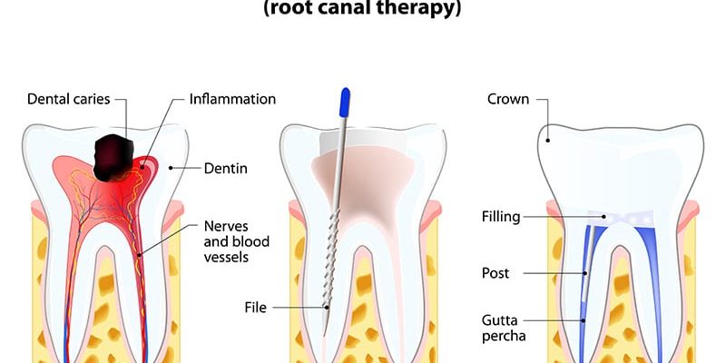 Pulpitis. root canal therapy. Infected pulp is removed from the tooth and the space occupied by it is cleaned and filled with a gutta percha. Post inserted to support crown