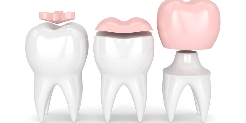 3d render of teeth with inlay, onlay and crown filling over white background