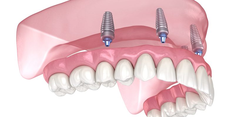 Maxillary prosthesis with gum All on 4 system supported by implants. Medically accurate 3D illustration of human teeth and dentures