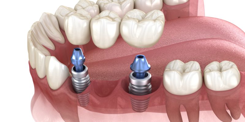 Dental,Bridge,Supported,By,Implants.,Medically,Accurate,3d,Illustration,Of