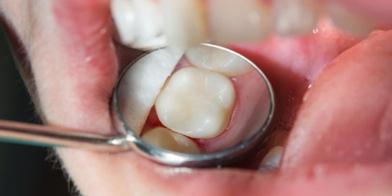 Close-up,Of,A,Human,Rotten,Carious,Tooth,At,The,Treatment