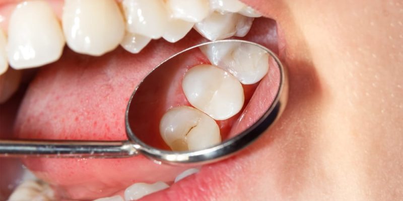 Dental,Treatment,In,The,Dental,Clinic.,Rotten,Carious,Tooth,Close-up