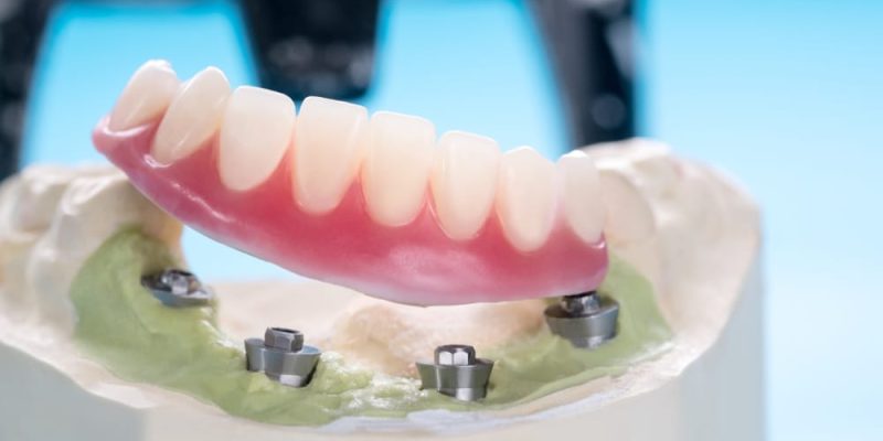 Closeup/,Dental,Implants,Supported,Overdenture,On,Blue,Background/,Screw,Retained/