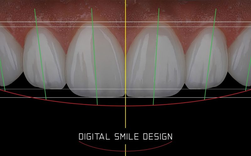 In,Aesthetic,Dentistry,,Digital,Smile,Design,Involves,Creating,An,Enhanced