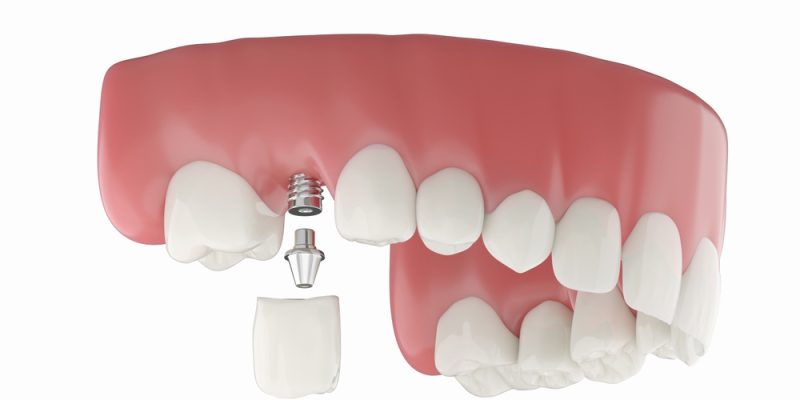 Dental,Implant,At,Molar,Teeth,,Isolated,White,Background.,3d,Rendering.